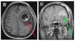 左脑胶质细胞瘤术后 临床诊疗验案