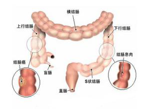 结肠癌患者的中医治疗效果怎么样呢？