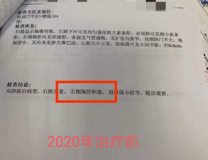 癌症胸腔积液怎么治疗？肺癌胸腔积液中医治疗案例