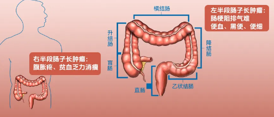 结直肠癌的5个预警信号，需注意观察