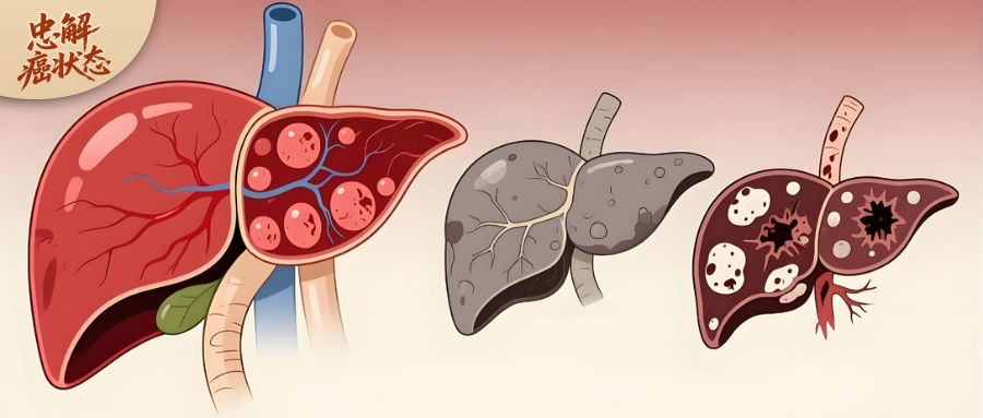 乙肝到肝癌，别只想着“一刀切”，这3件事更重要