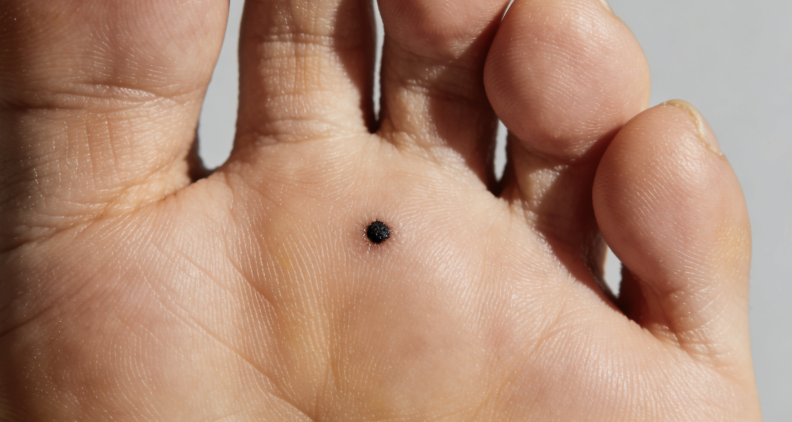 别抠！5个部位“高危痣”，比普通痣危险10倍