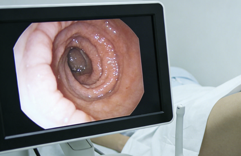 仅次于肺癌，却最易被误诊！结直肠癌的4个“伪装”，一定要认清