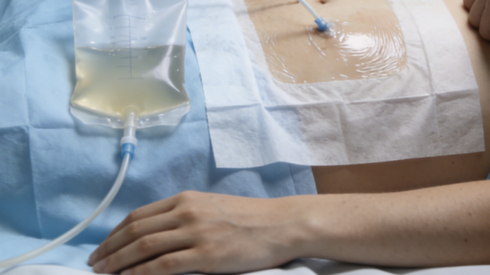 肝癌合并腹水，还能“正常生活”吗？做好这4件事是关键